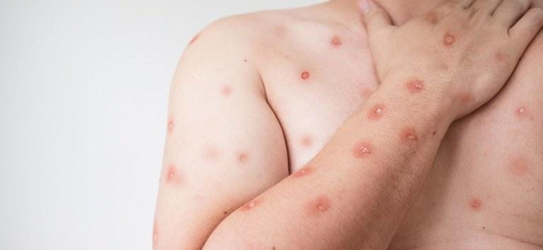 SES alerta para monitoramento de casos de Mpox em MT após avanço em Rondônia